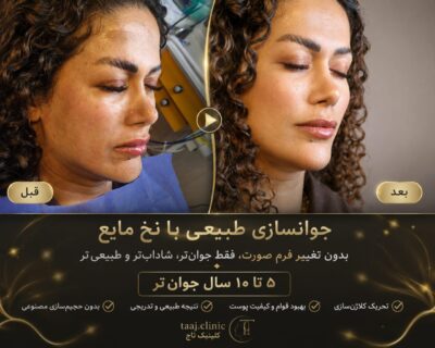 جوانسازی طبیعی با نخ مایع
